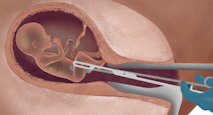 abortion, Live Action, prenatal diagnosis, kansas, late abortion, abortion, D&E