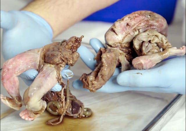 Baby Holly was dismembered by a D&E abortion in a Washington DC abortion facility. Photo courtesy of Progressive Anti-Abortion Uprising. Justice for the Five