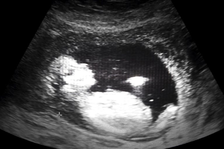 13 weeks gestation (11 weeks post fertilization)