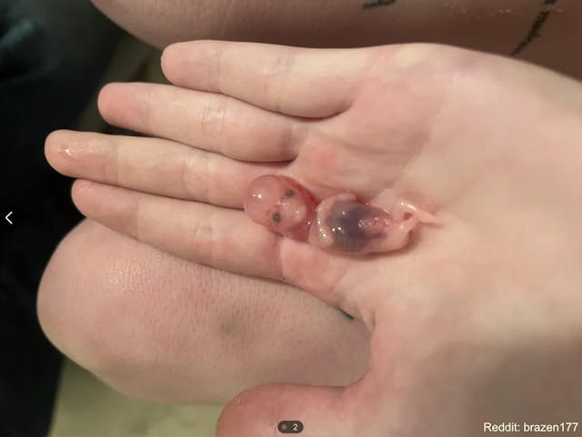 Photo of 10-week aborted baby: Reddit user brazen 177 Sam’s Club says abortion pill pharmacy listing was ‘incorrect information’ from ‘third-party vendor’ image