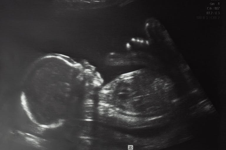 Image of baby in mother’s womb during ultrasound examination at 20 weeks 2 days.