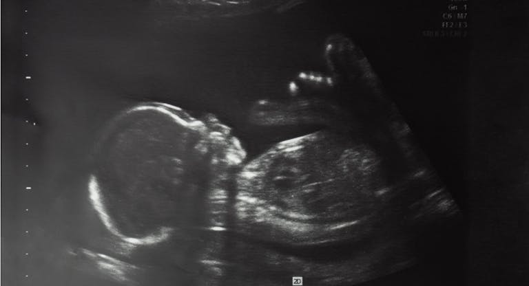 Image of baby in mother’s womb during ultrasound examination at 20 weeks 2 days.