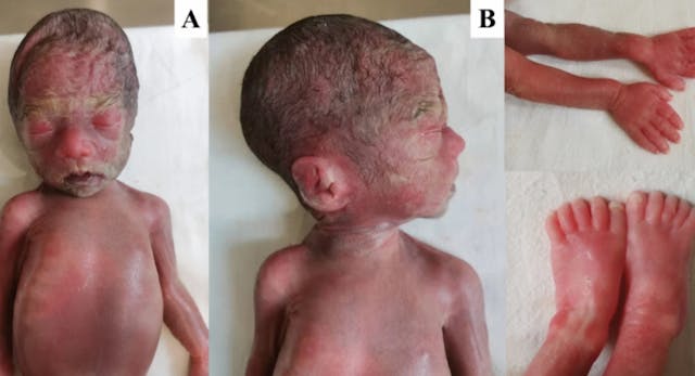 via https://molecularcytogenetics.biomedcentral.com/articles/10.1186/s13039-022-00584-3 aborted