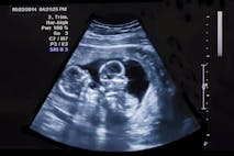 twins, abortion pill, abortion, twin