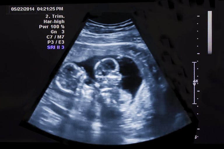 twins, abortion pill, abortion, twin