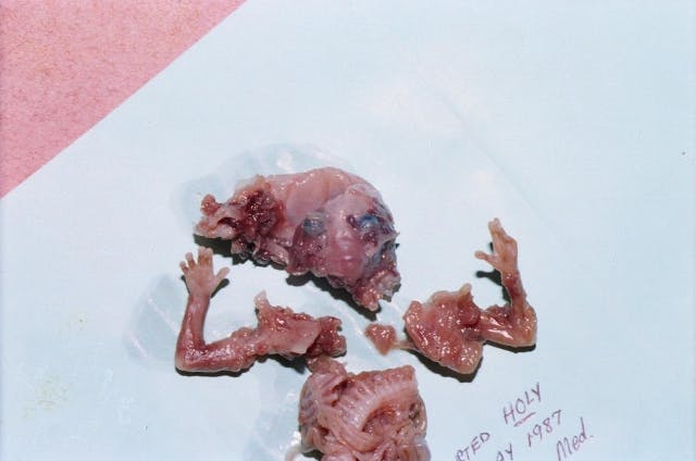 Alaska judge strikes down state law that allowed only physicians to commit abortions image