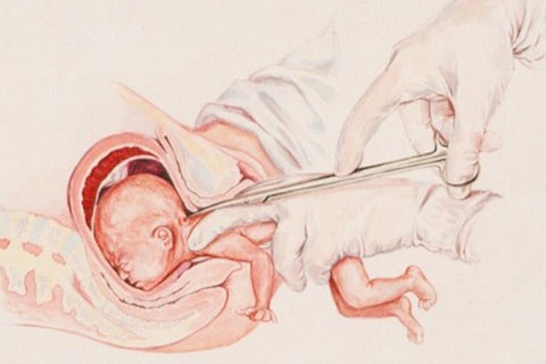 Partial-birth abortion (D&X) illustration partial-birth abortion