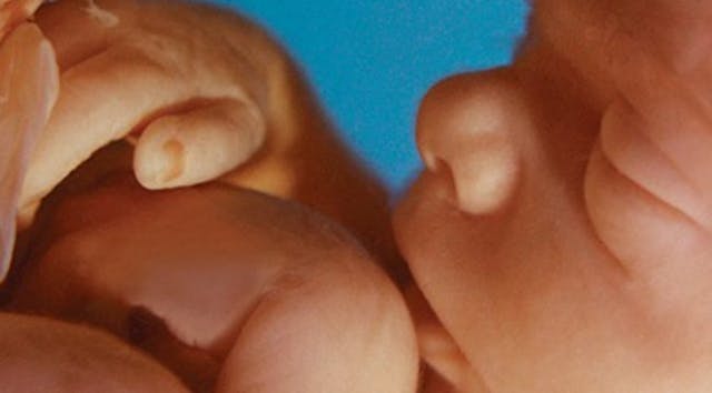Preborn child at 20 weeks. dismemberment abortion, born alive, medicare, fetal tissue, fetus, 20 weeks, late-term abortion