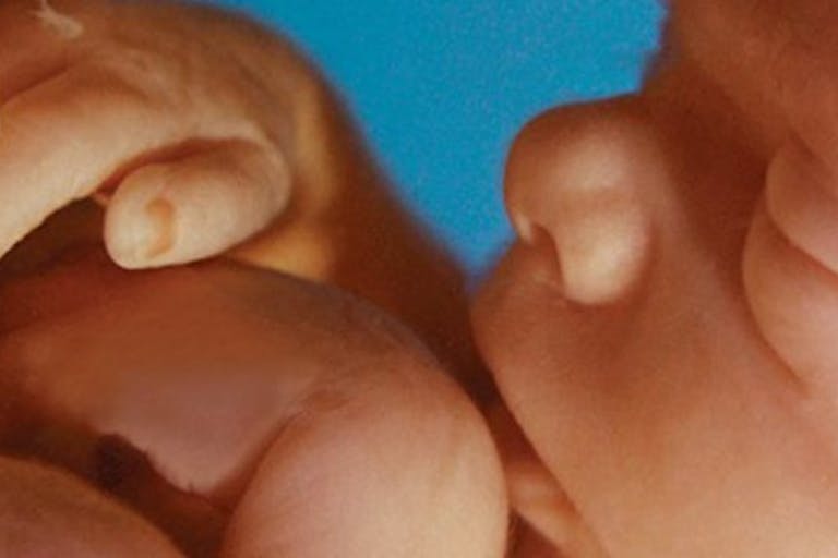 Preborn child at 20 weeks. dismemberment abortion, born alive, medicare, fetal tissue, fetus, 20 weeks, late-term abortion