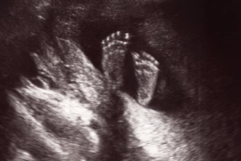 Little Big Feet in Uterus at 18 Weeks