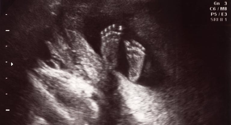 Little Big Feet in Uterus at 18 Weeks