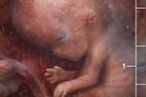 preborn fetus 9 weeks post-fertilization