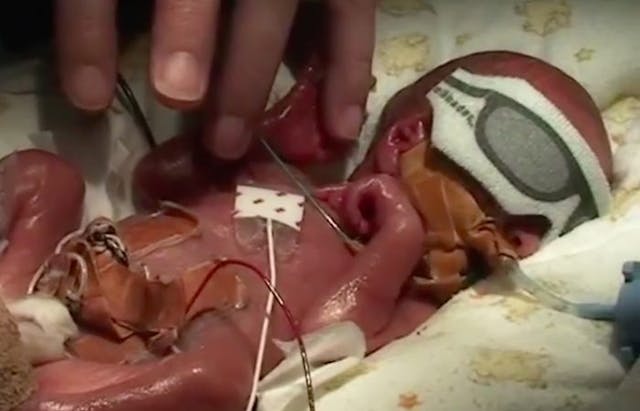 Video: Former Planned Parenthood medical director says aborted children can come out ‘looking like a baby’ image