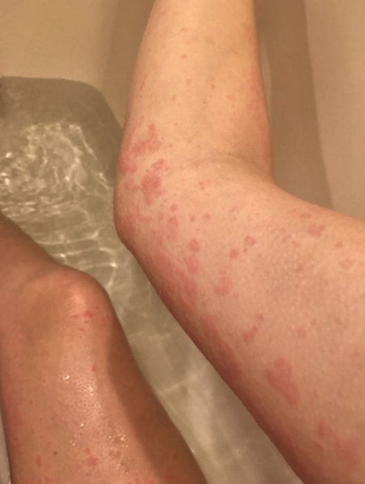 Hives on Melanie’s arm and leg (Photo courtesy of the author – do not reprint)