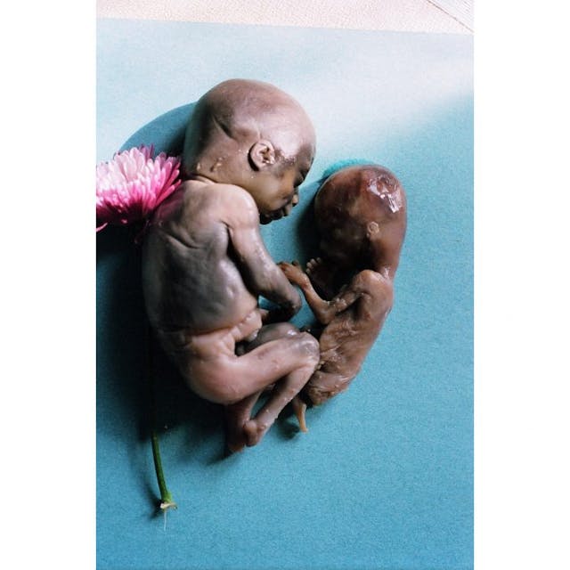 These two preborn children died at 21 weeks and 24 weeks gestation due to prostaglandin abortions.