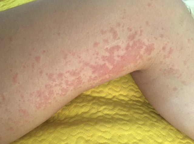 Hives on Melanie’s leg (courtesy of the author – do not reprint) Hives on Melanie’s leg (courtesy of the author – do not reprint)