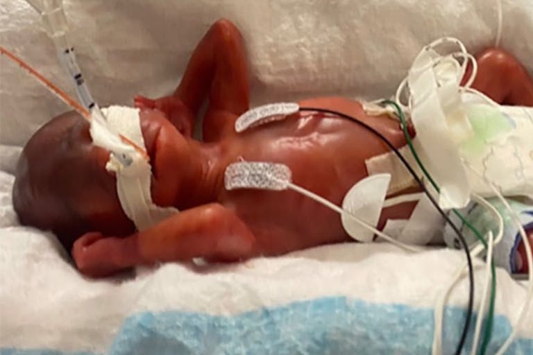 Curtis Means 2 World’s youngest preemie, born just over 21 weeks, celebrates his fourth birthday featured image