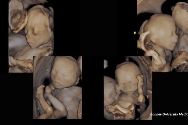 quadruplets, identical