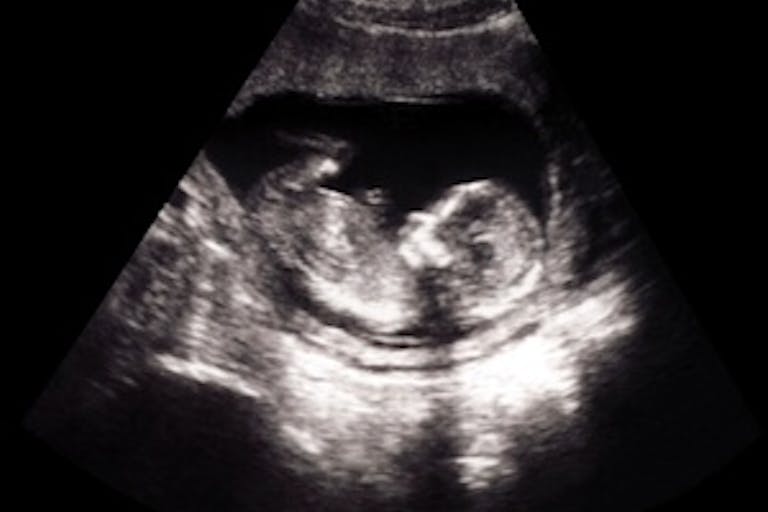 ultrasound