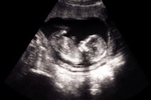 ultrasound