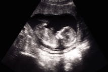 pro-life, Georgia heartbeat, abortion restrictions