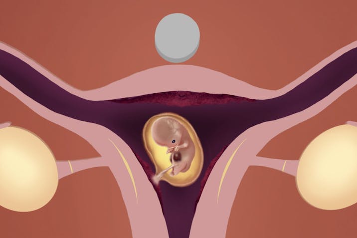abortions, abortion pill reversal