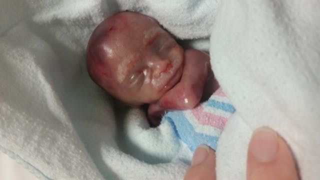 Baby Greyson, miscarried at 19 weeks. FACT CHECK: Georgia woman complains about pro-life law, despite the abortion she received image