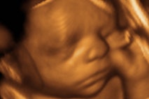 ultrasound, Vermont