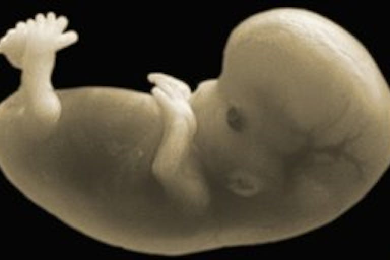 early abortion, first trimester, aborted