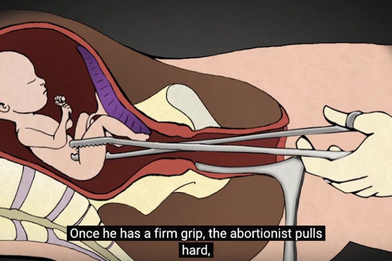Colorado, D&E, Arizona, Wyoming, abortion, South America, dismemberment