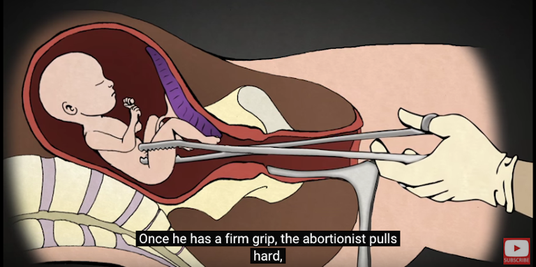 Colorado, D&E, Arizona, Wyoming, abortion, South America, dismemberment