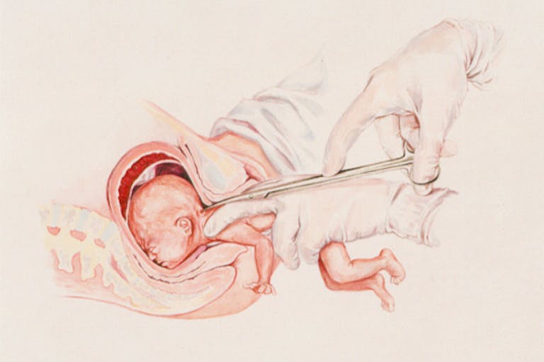 abortion