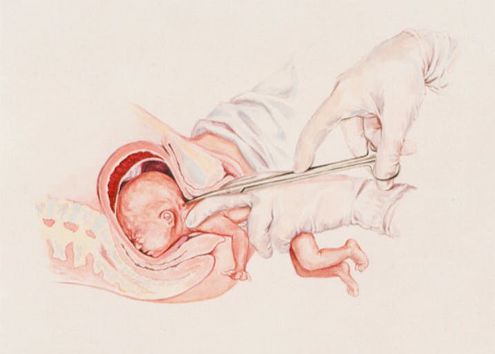 abortion