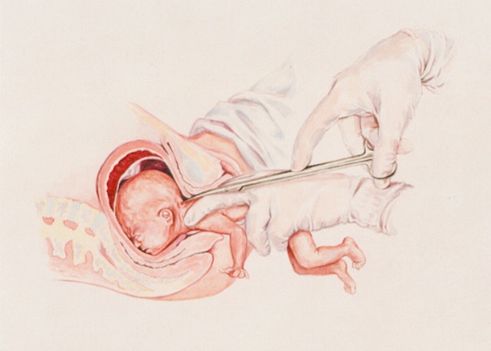 abortion