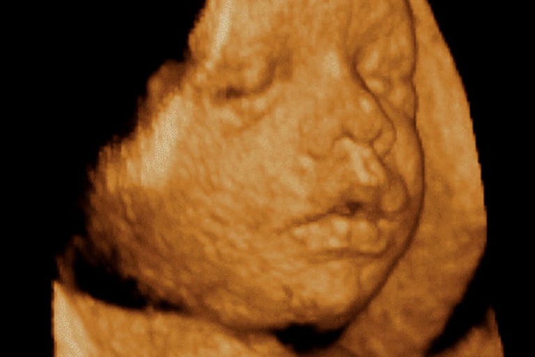 abortion