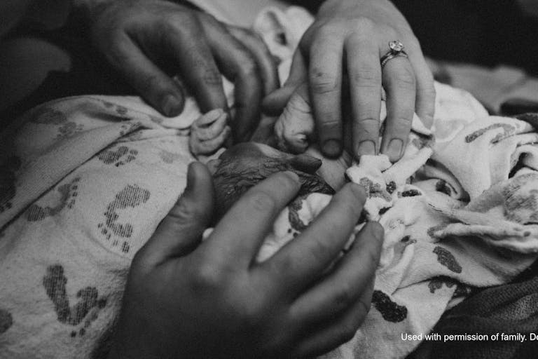 baby emanuelle trisomy 18