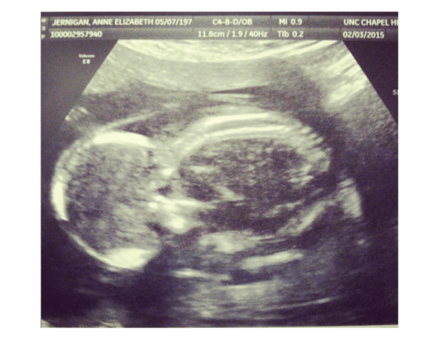 Vivianne’s ultrasound. Photo courtesy of the Jernigan family.