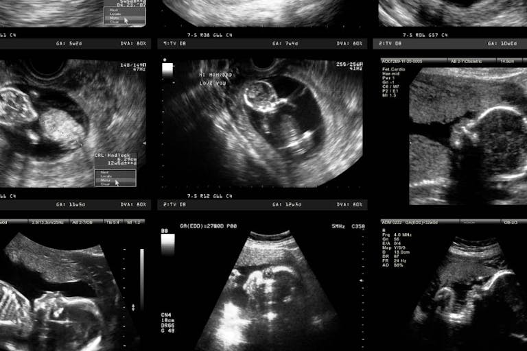 Pregnancy Ultrasound