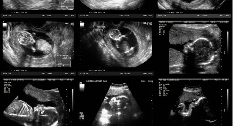 Pregnancy Ultrasound