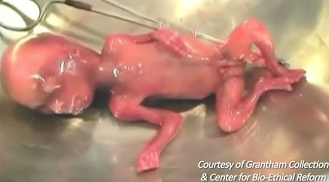 Photo of aborted baby left to die, from the Grantham Collection (not the baby mentioned in this article) Nurse traumatized by gasping abortion survivor was met with callousness: ‘You didn’t see that’ image