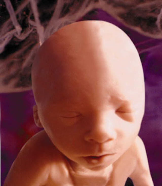 A human baby at 24 weeks A human baby at 24 weeks, after the first trimester