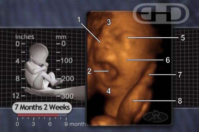 third trimester abortion restrictions