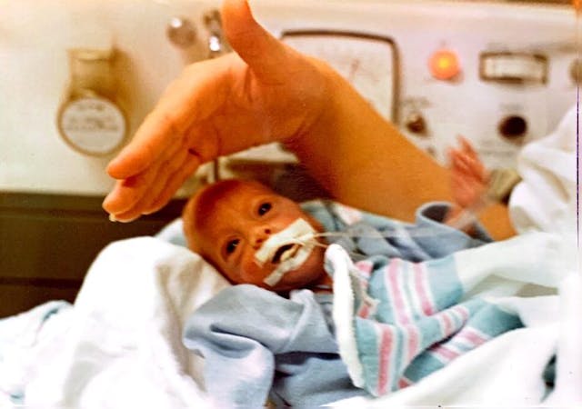 Lauren Eden, abortion survivor, shortly after her premature birth. Georgia, Lauren Eden
