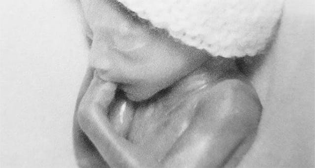 Outrageous abortionist Warren Hern thinks lethally injecting a child in utero is not an abortion image