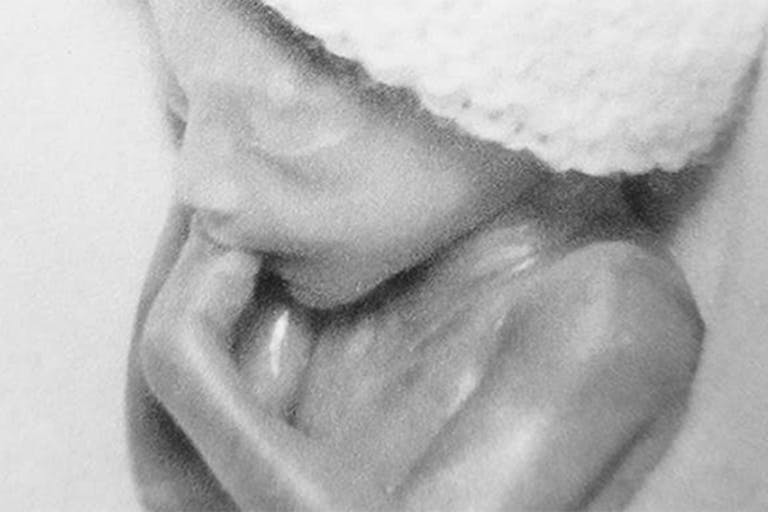 Baby Madalyn, born at 21 weeks, who died two hours after birth Outrageous abortionist Warren Hern thinks lethally injecting a child in utero is not an abortion image