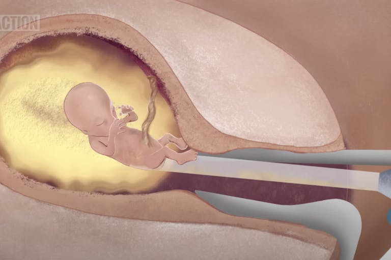 first trimester D&C abortion screenshot