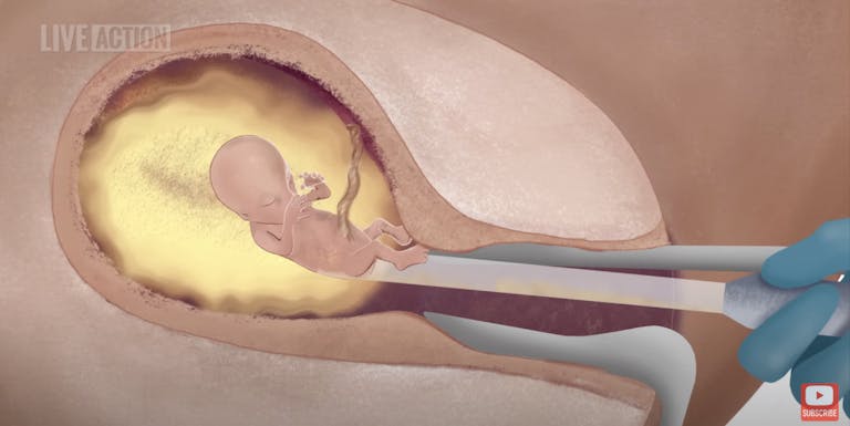 first trimester D&C abortion screenshot