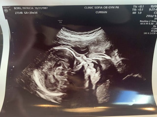Michael’s ultrasound (courtesy of Tricia Borg)