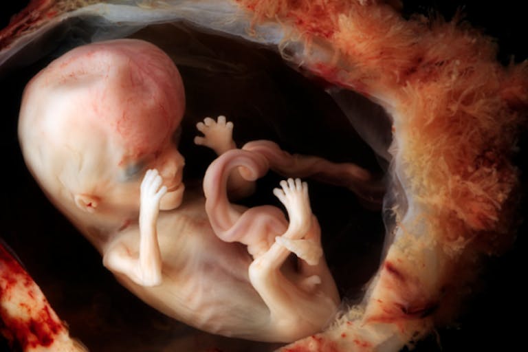 fetal, abortion, abortionist