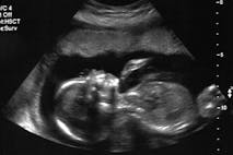 abortion, ultrasound, BBC, pregnancy, abortion restrictions